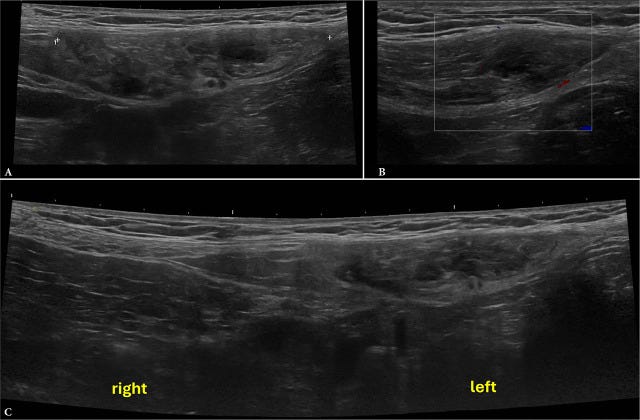 Hematoma ecografia tempo formacion 1.jpg
